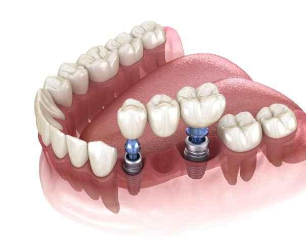 invisalign Ramsgate